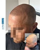 Ultra Scalp Micropigmentation Ryan Krupnick